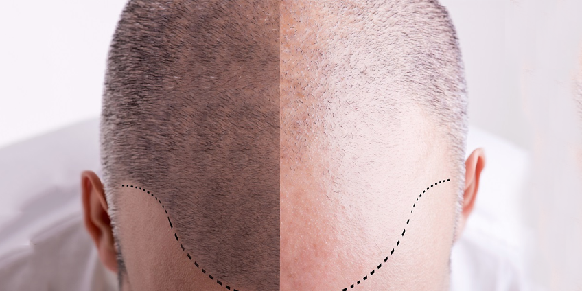 What is Scalp Micropigmentation.